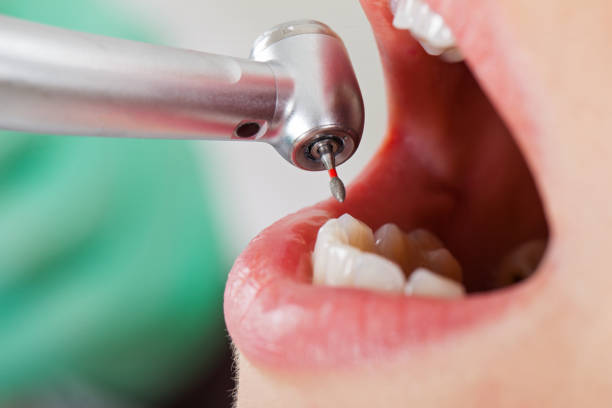 Best Chipped Tooth Repair Near Me  in Spring Valley, MN